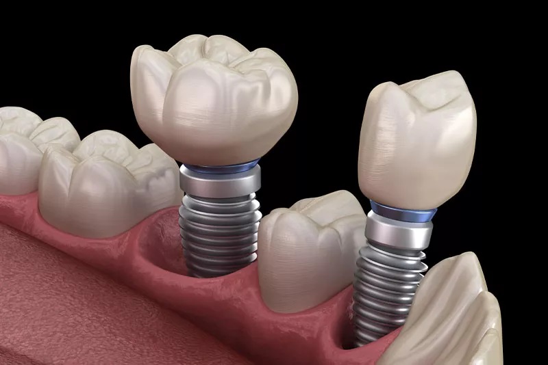 2 implants 2