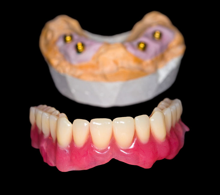 31417325 - removable denture and gypsum model on isolated black