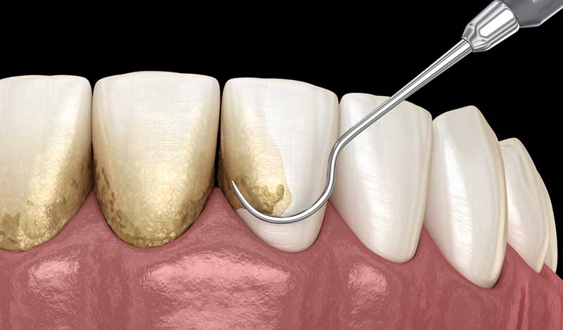 Oral hygiene: Scaling and root planing (conventional periodontal therapy). Medically accurate 3D illustration of human teeth treatment