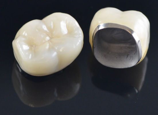 porcelain-metal-crowns