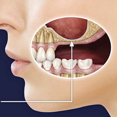 sinus2-